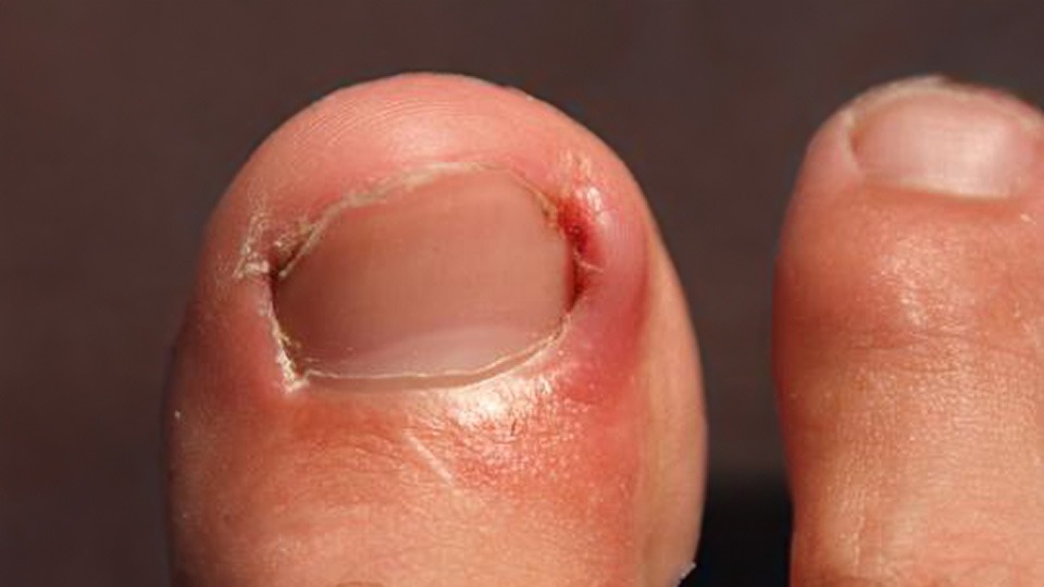 Ingegroeide-teennagel-Jose-Lauwers Ingegroeide teennagel José Lauwers medisch pedicure Den Haag